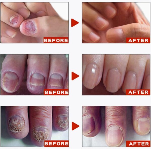 Fungal Nail Treatment Cream,Antifungal Nail Polish Cream,Nail Fungus Treatment for Toenail,Strong Anti-Fungal Toenail Cream,Nail Improve Cream,Nail Repair Cream for Thick Cracked Discolored Nails