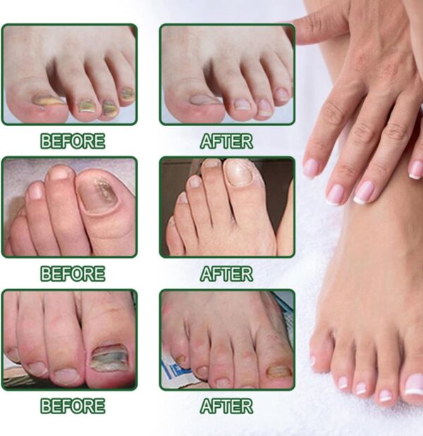 Ginger Nail Treatment Nail Support Nail Care,Fungal Nail Treatment,Ginger N/ail Growth Treatment Serum,7 D/ays Na/il Treatment,Na/il Strengthener for Damaged Nails,Nai/l Hardener,Nai/l Repair