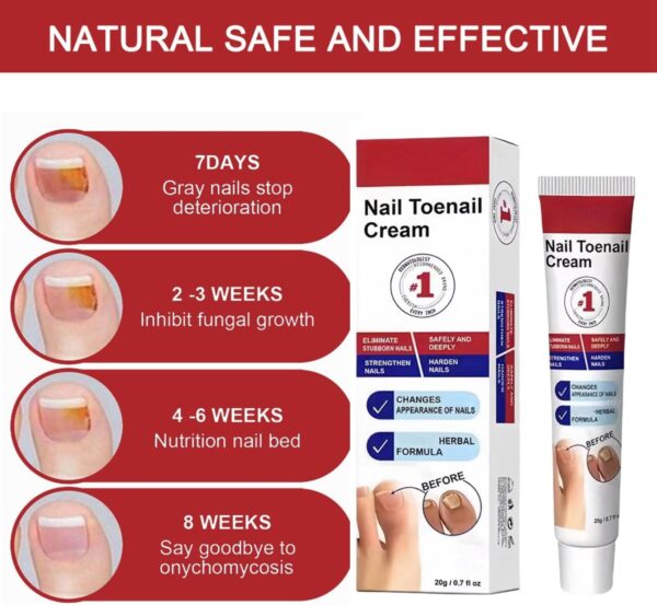 Fungal Nail Treatment Cream,Antifungal Nail Polish Cream,Nail Fungus Treatment for Toenail,Strong Anti-Fungal Toenail Cream,Nail Improve Cream,Nail Repair Cream for Thick Cracked Discolored Nails