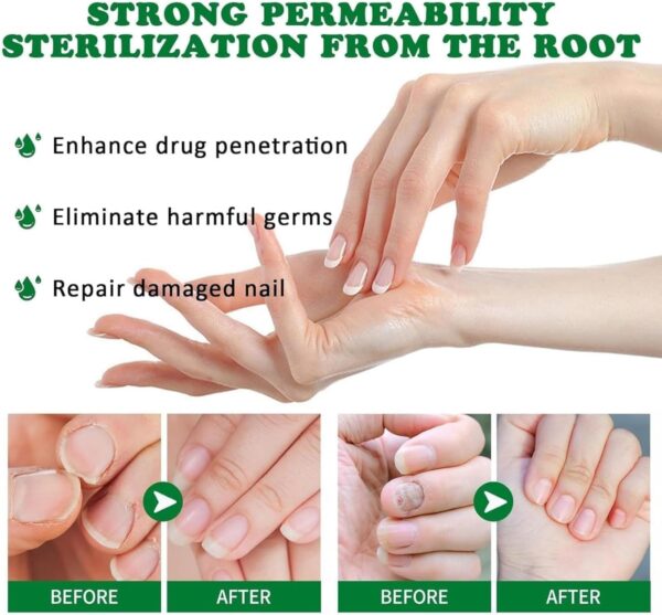7 Days Nail Fungus Treatment Toenail Fungus Treatment Extra Strength-Ginger Nail Treatment,Toenail Cuticle Care Oil Care,Multi-Purpose Nail Repair for Your nails a Natural Shine (1)