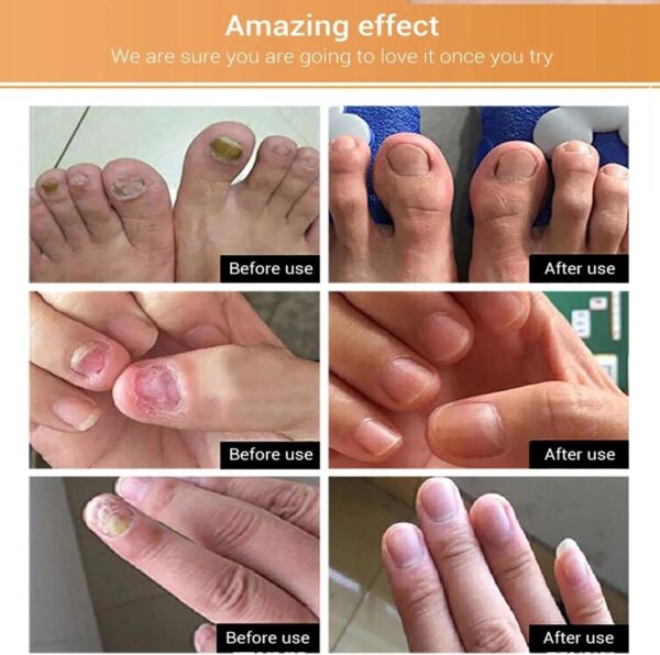 Nail Care Essence - Fingernail & Toenail Care Solution