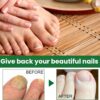 Ginger Nail Treatment Nail Support Nail Care,Fungal Nail Treatment,Ginger N/ail Growth Treatment Serum,7 D/ays Na/il Treatment,Na/il Strengthener for Damaged Nails,Nai/l Hardener,Nai/l Repair