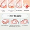 40 Pcs Toenail Correction Patch,Ingrown Toenail Corrector Set,Pain-Free Toenail Straightener Strips with Toenail Lifter,Toenail Correction for Ingrown Toenails for Women Men Foot Care