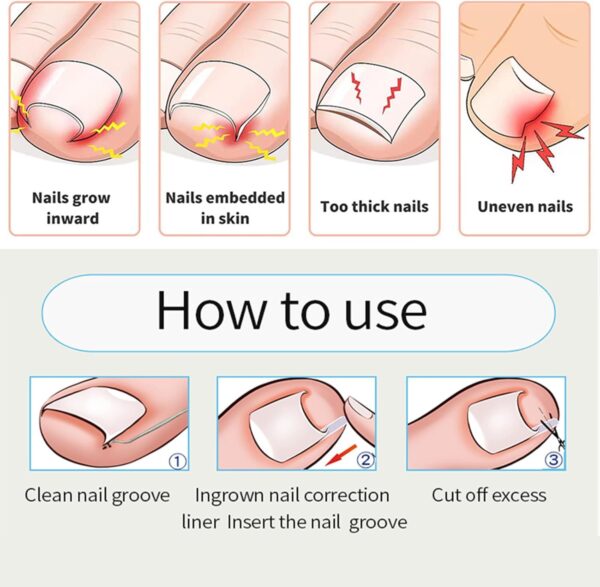 40 Pcs Toenail Correction Patch,Ingrown Toenail Corrector Set,Pain-Free Toenail Straightener Strips with Toenail Lifter,Toenail Correction for Ingrown Toenails for Women Men Foot Care