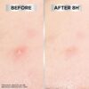 Garnier Blemish Patches, Hydrocolloid patches to reduce the appearance of spots in 8 hours, Ultra-thin & Invisible on all skin tones, Suitable For All Skin Types, Vegan Formula, 22 Patches