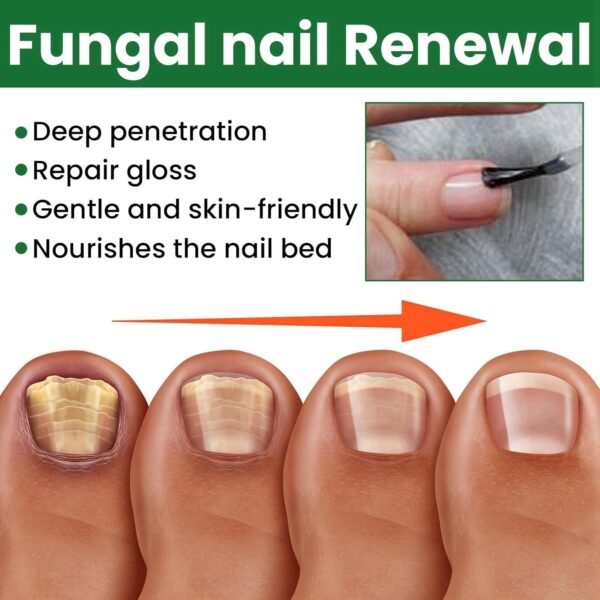 Ginger Nail Treatment Nail Support Nail Care,Fungal Nail Treatment,Ginger N/ail Growth Treatment Serum,7 D/ays Na/il Treatment,Na/il Strengthener for Damaged Nails,Nai/l Hardener,Nai/l Repair