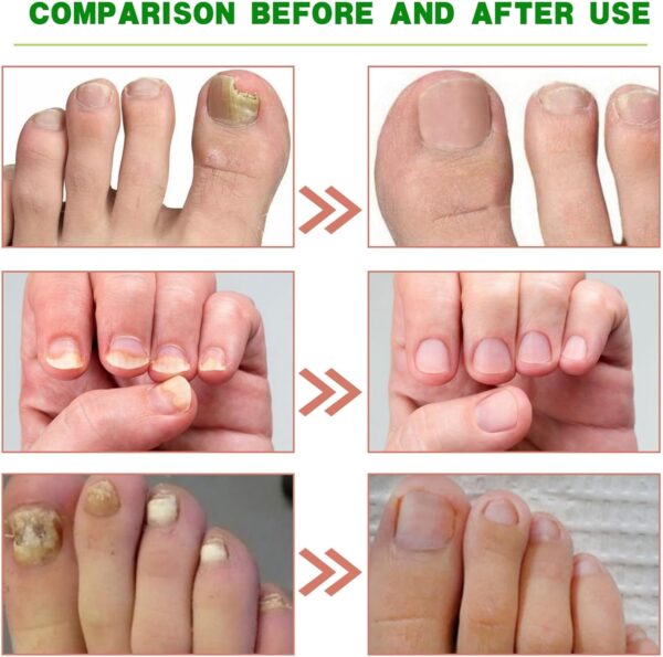 Ginger Nail Treatment Nail Support Nail Care - Ginger Nail Growth Serum, 7 Days Nail Treatment, Ginger Cuticle Care Oil for Nails, Nail Strengthener For Damaged Nails, Fungal Nail Treatment