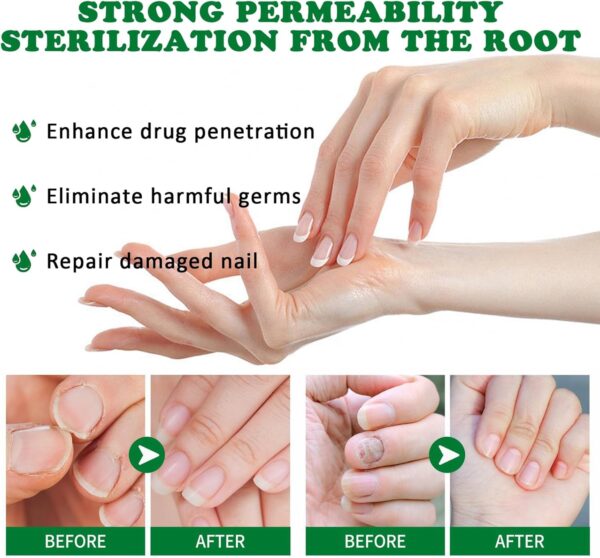 Ginger Nail Treatment Nail Support Nail Care - Ginger Nail Growth Serum, 7 Days Nail Treatment, Ginger Cuticle Care Oil for Nails, Nail Strengthener For Damaged Nails, Fungal Nail Treatment