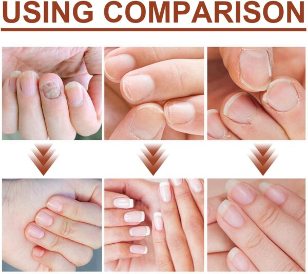 2PCS Fungal Nail Treatment Pen for Toenails and Fingernails,Nail Fungus Treatment for Toenail,Anti Fungal Nail Treatment,toe nail fungal treatment,nail repair essence,Anti Fungus Nail Strengthener