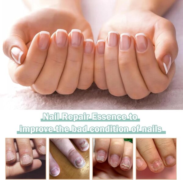 Nail Care Pens, 2Pcs Fungal Nail Treatment Pen, Fungal Nail Treatment for Toenails, Nail Repair Pen, Natural Ingredients Nail Serum for Strengthener Nail