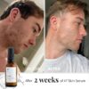 47 Skin | Hydrating Face Serum with Silver Chitoderm for ALL Skin Types | Clears Acne, Prevents & Heals Breakouts & Blemishes, Repairs Scars | Moisturises and Nourishes For Smooth Skin | 30ml