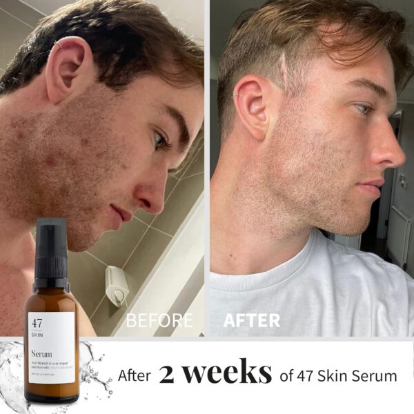 47 Skin | Hydrating Face Serum with Silver Chitoderm for ALL Skin Types | Clears Acne, Prevents & Heals Breakouts & Blemishes, Repairs Scars | Moisturises and Nourishes For Smooth Skin | 30ml
