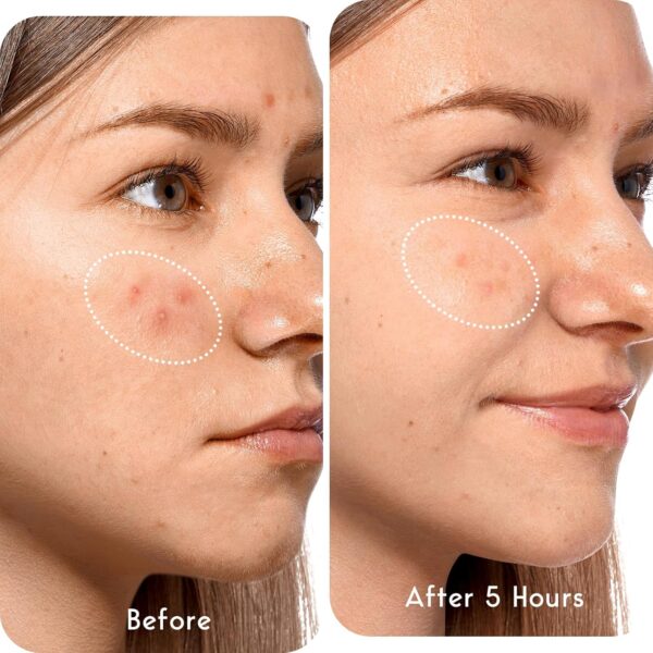 81w5ZQ0W4-L._AC_SL1500_.jpg LitBear 84 Patches 5 Size Acne Patches Large, Hydrocolloid Pimple Patches for Large Breakouts, Zit and Blemish, Large Acne Patches for Face, Chin, Back and Body with Tea Tree Oil