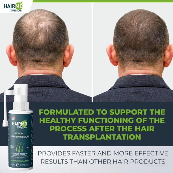 HairMD Transplant Clinical Repair Serum - 60ml Hair Regrowth Serum - Prevents Post-Transplant Hair Loss - Stimulates New Hair Growth - Fast and Effective Results - Gentle Formula